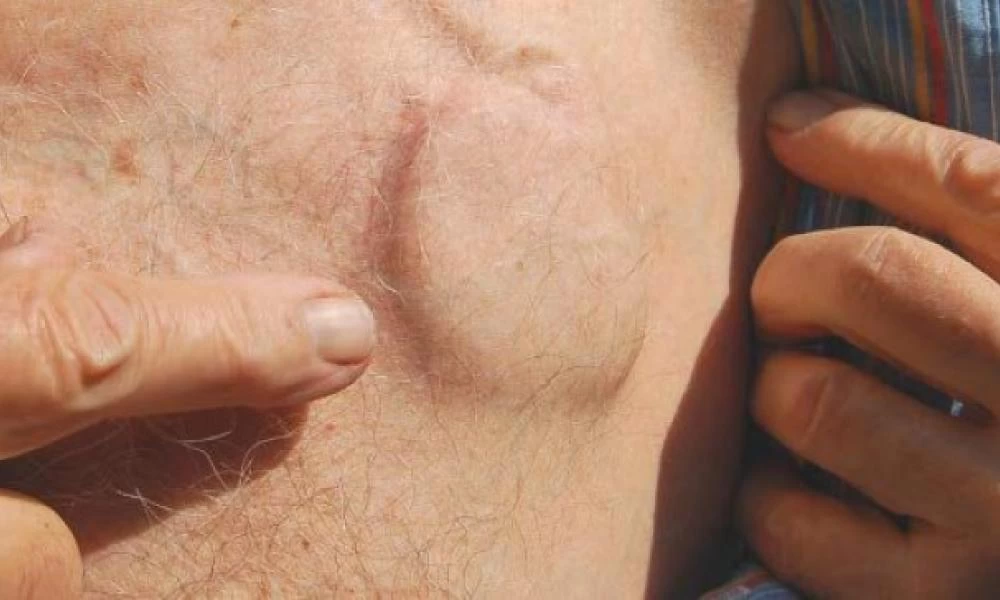 Αν έχετε βηματοδότη μείνετε μακριά από… iPhones!